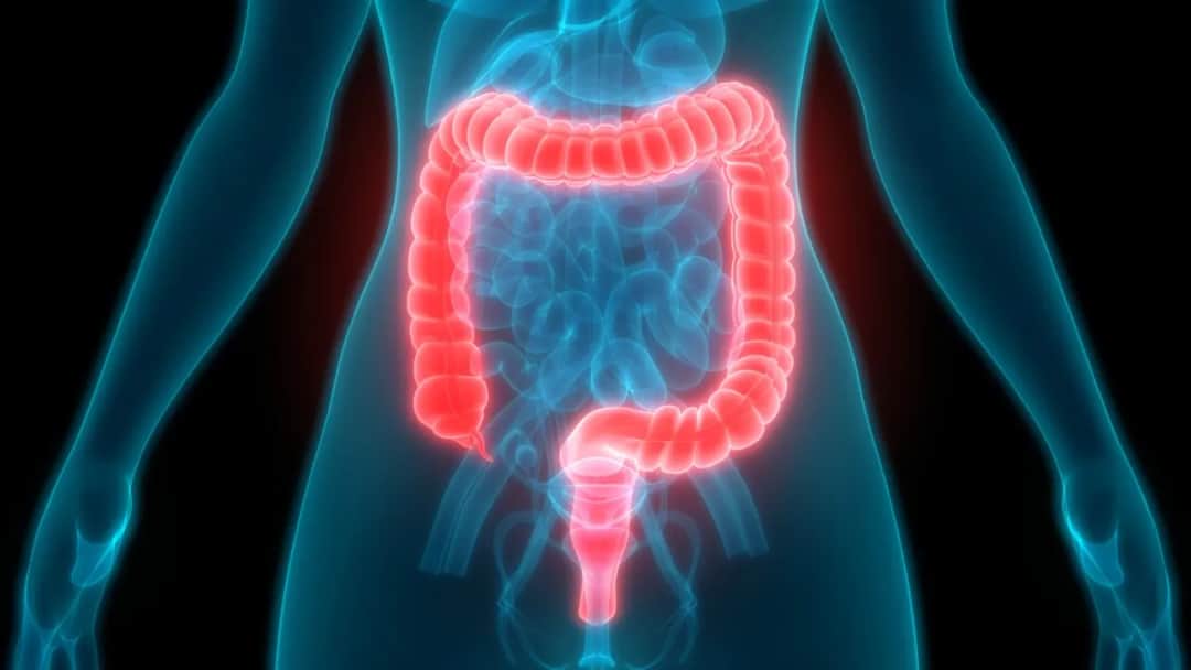 Rak jelita grubego: Wczesne objawy, które ratują życie. Sprawdź!
