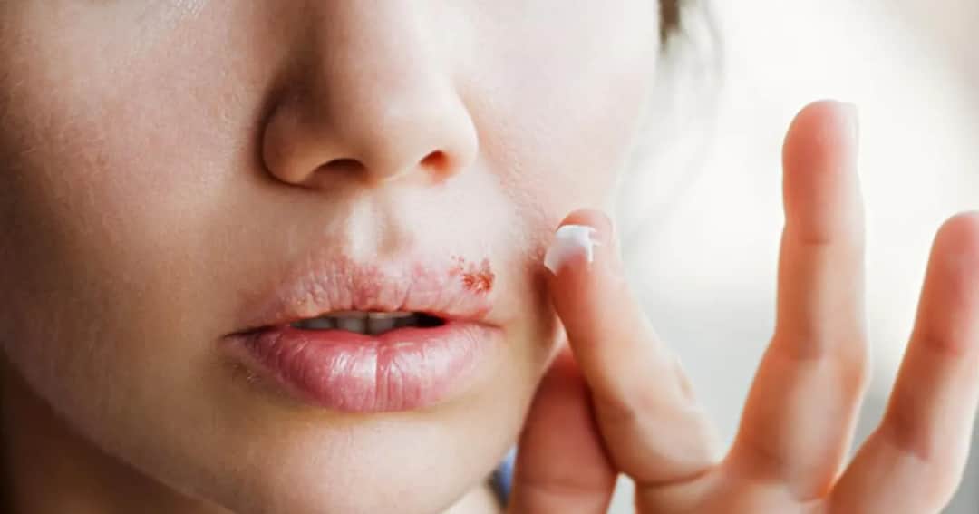 Opryszczka: Jak skutecznie zapobiegać nawrotom? Twój plan działania