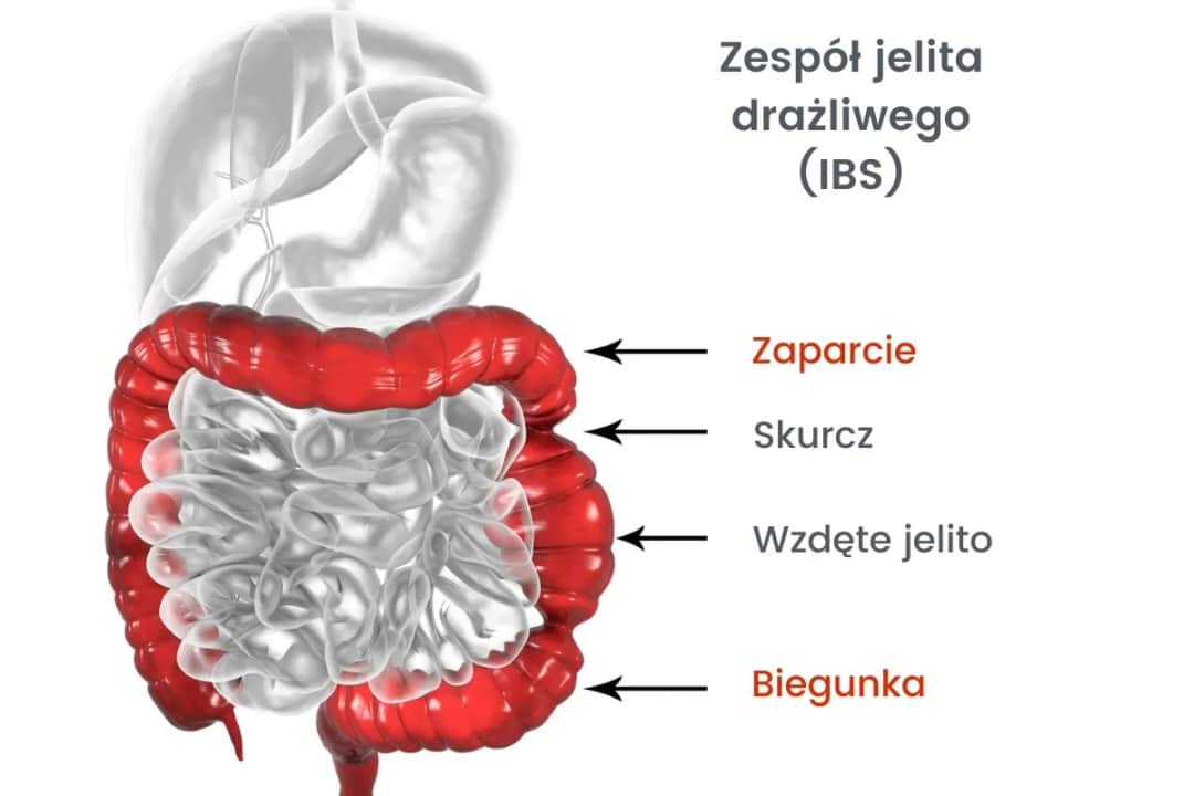 Objawy jelita drażliwego: co mówią jelita? Czerwone flagi IBS