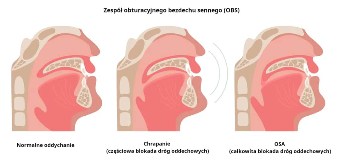 Chrapanie: Jak odzyskać cichy sen? Domowe triki i leczenie OBS.